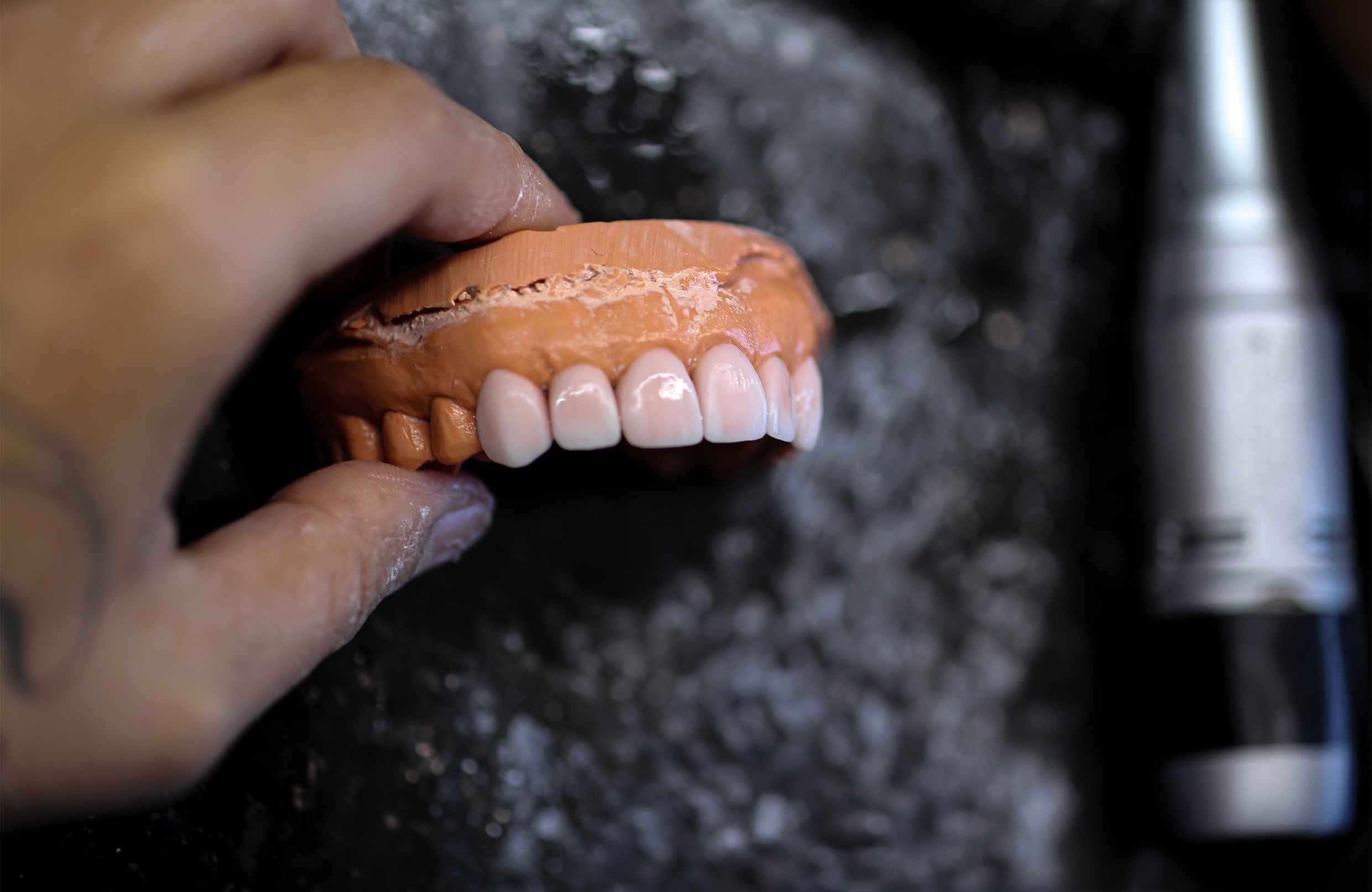 Dental veneer and crown preparation on a model.